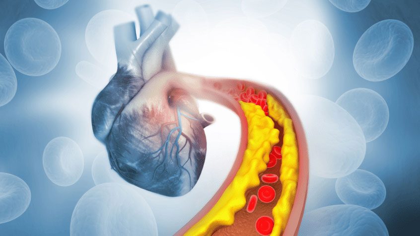 Read more about the article What is the link between Cholesterol and Heart Diseases?