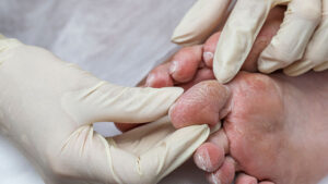 Read more about the article What Causes Diabetic Foot?