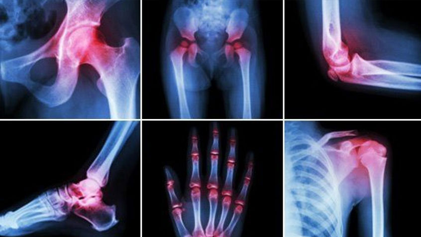 Read more about the article What are the Types and Treatments for Arthritis?