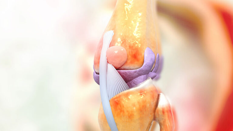 How to Prepare for Joint Replacement Surgery? Step-by-Step Guide