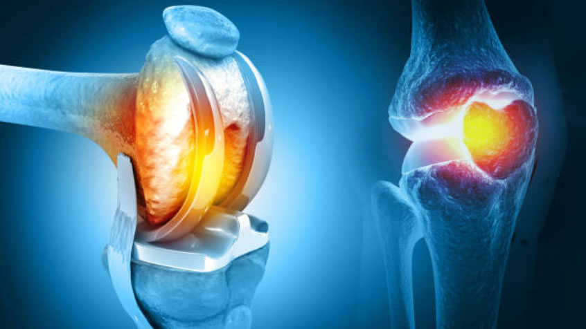 You are currently viewing  Knee Replacement Surgery: What Patients Should Know?