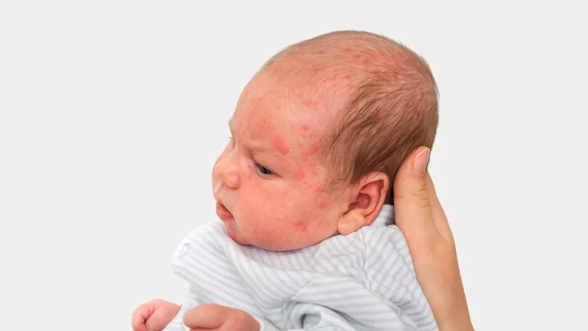 Read more about the article First Thing You Should Do If Your Baby Has a Skin Rash