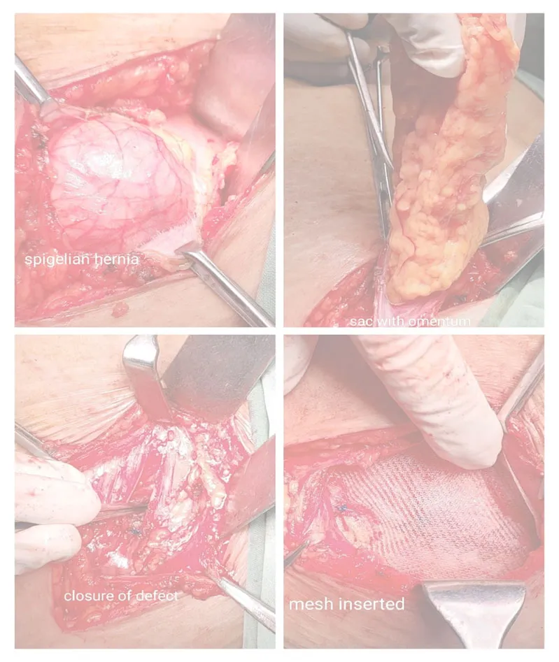 Spigelian-hernia2