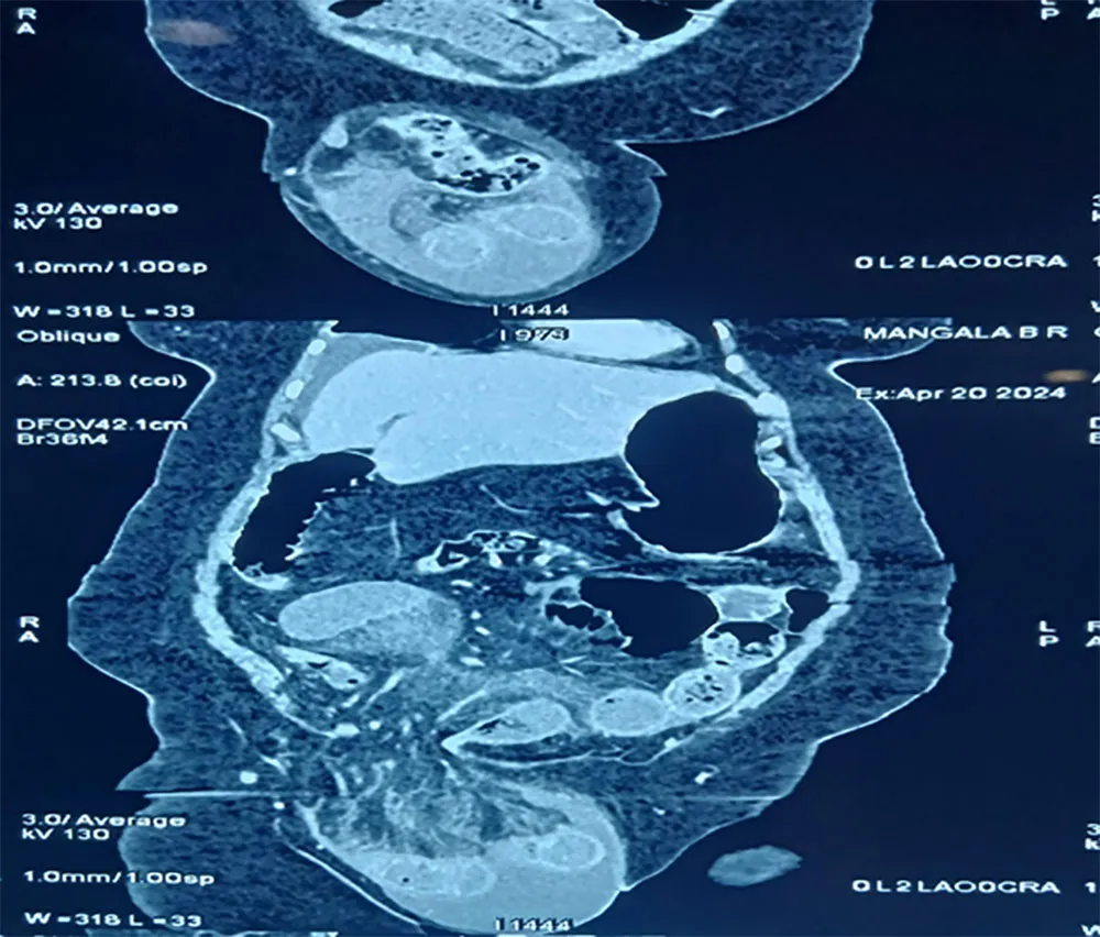 labial-hernia-scann-image