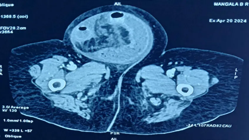 labial-hernia-scann-image1