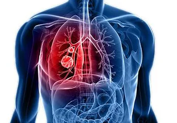 pulmonary medicine