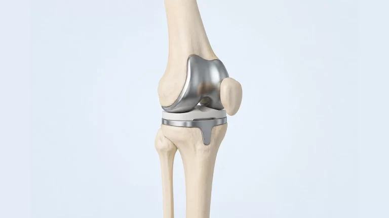 Knee Replacement Surgery Cost in Bangalore. Complete Guide