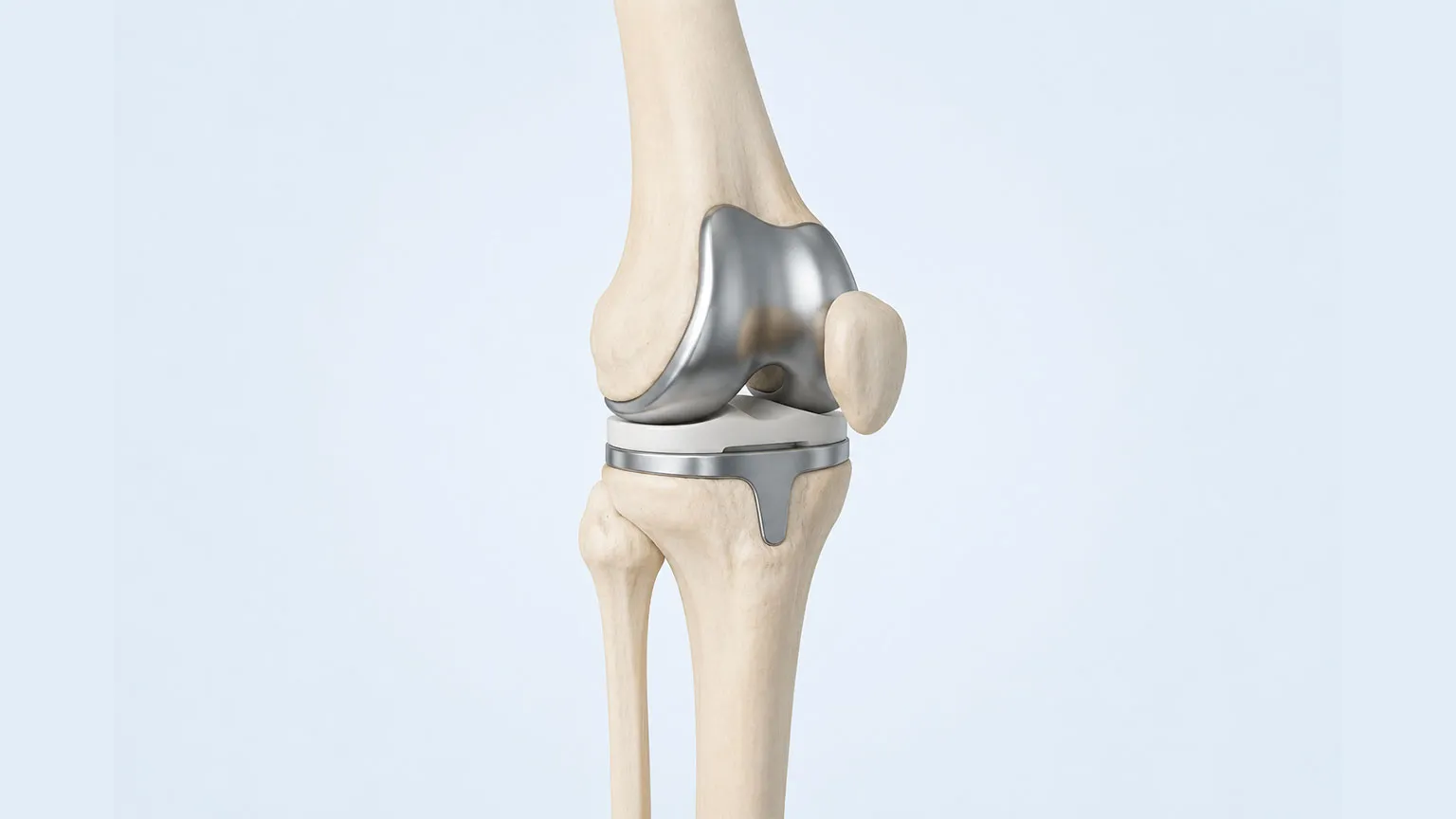 Knee-Replacement-Surgery